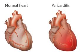 Retentia de apa apare atunci cand organismul retine in tesuturi mai multa apa decat are nevoie. Pericardita Lichid La Inima Cauze Simptome Tratament