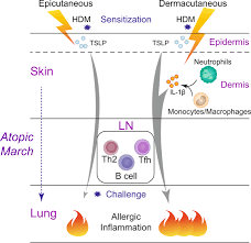 Image result for Allergic Triad