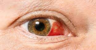 Que Es El Derrame Ocular Instituto Oftavision Clinica De Ojos