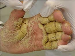 Image result for scabies norvegica