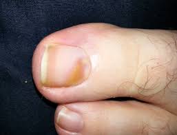 spot under toenail melanoma pictures