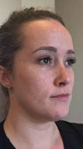 Dr. Howard Levinson empowers his patients through knowledge. Here, he  explains how a breast implant works within the body. Interested in learning  more? Schedule a consultation with him