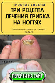 как избавиться от грибка на ногах в домашних условиях Tri Recepta Lecheniya Gribka Na Nogtyah Easy Food To Make Health Nail Fungus