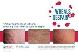 Wheels Of Despair Booklet Http Content Zone Secure Net Whealsofdespair Chronic Spontaneous Urticaria Urticaria Breaking Free