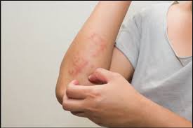 Travazol Krem Nasil Bir Seydir Faydalari Nelerdir Kullananlarin Yorumlari Cilt Bakimim Cilt Bakimim In 2020 Psoriasis Cure Psoriasis Treatment Psoriasis Remedies