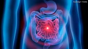 Außerdem findet eine ermittlung der entzündungswerte statt, um den verlauf einer bereits. Colitis Ulcerosa Beschreibung Symptome Behandlung Netdoktor