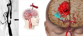An interruption or reduction in the supply of blood to the brain causes a cerebral stroke. Stroke Brain Attack Conditions Treatments Ucla Radiology Los Angeles Westwood Manhattan Beach Santa Monica Ca