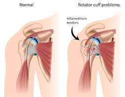 How To Prevent Rotator Cuff Injuries - Advanced Orthopedics Institute