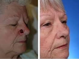 skin cancer inside nose that looks like a scab. Repairing The Nose After Skin Cancer In Just Eurekalert
