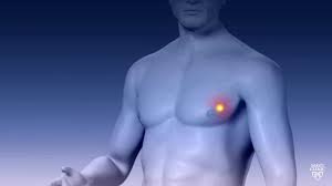 When a male offspring of a man with breast cancer inherits the brca2 gene, his chance of eventually developing breast cancer is how is male breast cancer treated? Male Breast Cancer Study Offers Insight On Treatment And Prognosis Tech Explorist