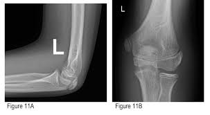Image result for Humerus Growth Plates
