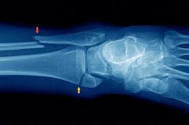 Image result for Ankle XRay