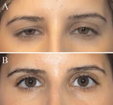 Müller's muscle–conjunctival resection for upper eyelid ptosis: correlation  between amount of resected tissue and outcome