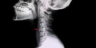 Image result for Vertebral Compression Fracture