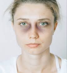 You've most likely been bruised a few times in your life. How To Get Rid Of Bruises Quickly