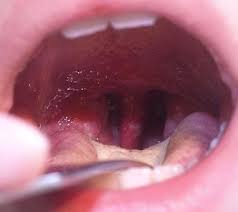 Image result for Strep throat infection roof of mouth