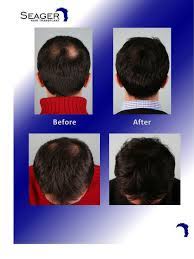 Dr Cam Simmons 12 Months After 1886 Grafts Were Transplanted To The Crown With S Z Double Whorl This Pa Hair Transplant Before And After Hair Transplant Hair