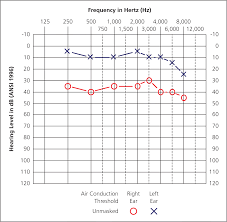 Audiometry Screening And Interpretation American Family Physician