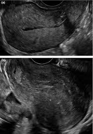 188 st heliers bay rd, st heliers, auckland. Sonographic Findings In Acute Puerperal Endometritis Rule 2018 Australasian Journal Of Ultrasound In Medicine Wiley Online Library