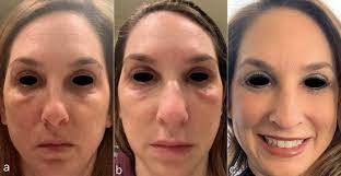 We did not find results for: Covid 19 Sars Cov 2 Virus Spike Protein Related Delayed Inflammatory Reaction To Hyaluronic Acid Dermal Fillers A Challenging Clinical Conundrum In Diagnosis And Treatment Springerlink