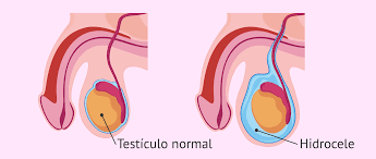 Que Es El Hidrocele Testicular Causas Sintomas Y Tratamiento