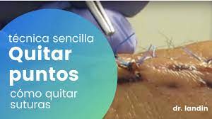 Como Quitar Puntos De Sutura How To Remove Stitches Youtube
