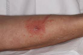 Image result for Rhus Dermatitis