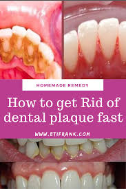 Thoroughly cleaning all surfaces of your teeth, between your teeth and under the cleaning between your teeth and under the gumline is crucial for biofilm and plaque removal and can help prevent gingivitis and tooth decay. How To Remove Plaque From Teeth Without Dentist Arxiusarquitectura