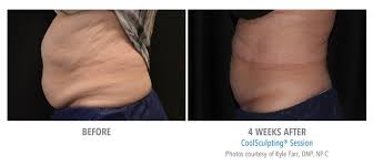 Photos courtesy of kathleen welsh, md. Coolsculpting Before And After Real Patient Photos Vein And Laser Institute