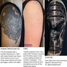Furthermore, lasers may not remove all the colors, which. Clean Slate Laser Tattoo Removal Experts Etusivu Facebook