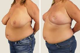 Maybe you would like to learn more about one of these? Breast Reduction Plastic Surgery Jonesboro Ar Majewski Plastic Surgery
