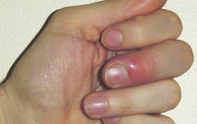 Une mauvaise coupe de l'ongle (trop court, en traitements : Ongle Incarne Ou Panaris