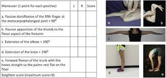 Postural Tachycardia Syndrome And Other Forms Of Orthostatic Intolerance In Ehlers Danlos Syndrome Autonomic Neuroscience Basic And Clinical