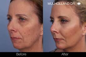 However, these treatments are accompanied by significant downtime along with risk of further scarring and infection. Toronto Fractional Co2 Laser Laser Skin Resurfacing Tps