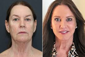 Woman, 66, Got a Facelift So Shocking, the Internet Thought It Was Fake:  PHOTOS (Exclusive)
