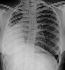 X Ray Chest Pa View A Homogeneous Opacity In The Right Open I