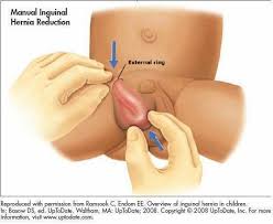 Apa punca sebenar angin pasang? Tips Untuk Mencegah Kanak Kanak Daripada Terkena Hernia Angin Pasang Bidadari My