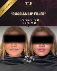 Lip Filler Tips: Migrating Filler Safely for Natural Results