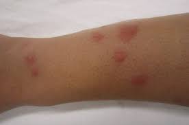 Maybe you would like to learn more about one of these? Gigitan Kecoa Ciri Ciri Akibat Dan Cara Menanganinya Fumida