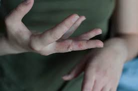 Tanda dan simptom kudis buta. Kudis Scabies Penyebab Gejala Hingga Pengobatan