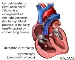Cor Pulmonale Medlineplus Medical Encyclopedia Image