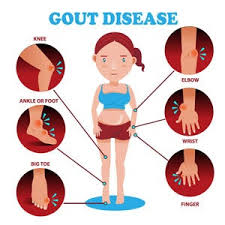 Image result for gout symptoms knee