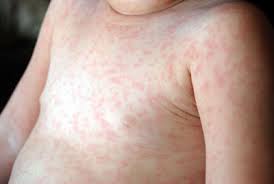 This is caused by certain kinds of viruses that have been known to affect roseola, or sixth disease, is a highly infectious disease that affects babies and young children. Roseola Infantum India Parenting