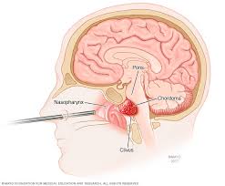 Endoscopic skull base surgery