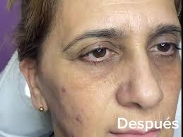Blefaroplastia no quirúrgica + mesoterapia despigmentante para ojeras ¿Que  te pareció?
