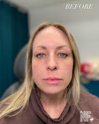 Just a little pop to help smooth & support the under-eye & lateral cheek  transition ✨ The perfect place to start before jumping for the under-eye  filler. This beautiful mama & boss