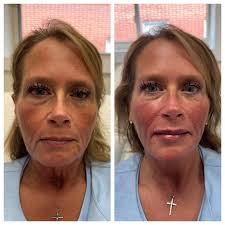 Brooke Ball, RN-BSN (@abaestheticsky) · Middlesboro, KY