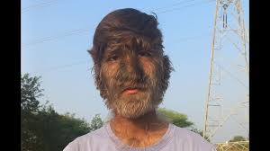 Image result for Hypertrichosis