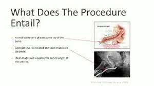 Image result for Voiding Cystourethrogram