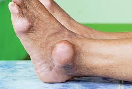 The lateral malleolus is the lower end of the fibula, one of the lower leg bones. Why Does My Ankle Hurt 15 Possible Causes Of Ankle Pain